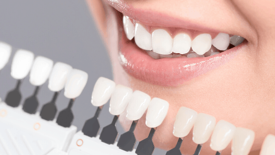 Benefits of Teeth Whitening Local Family Dentistry in Salem and Monmouth OR