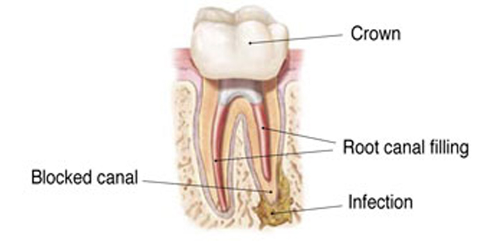 Root Canal Treatment Local Family Dentistry in Salem OR