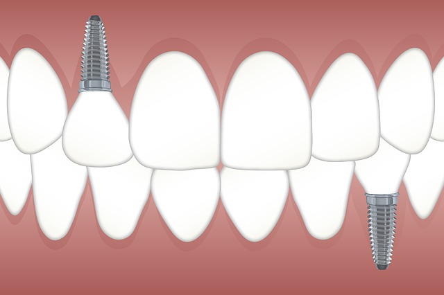 3 Steps to Dental ImplantsDental Implant Local Family Dentistry in Salem OR