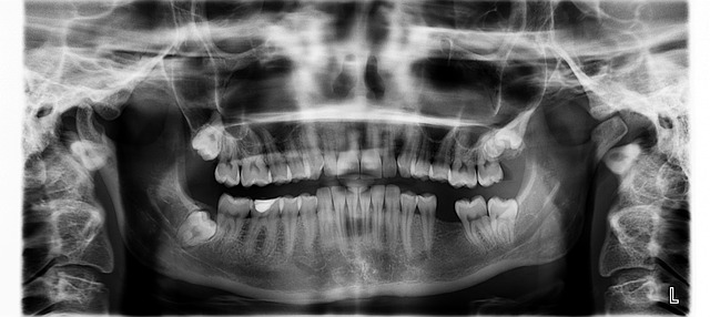 Wisdom Teeth Extractions Local Family Dentistry in Salem OR